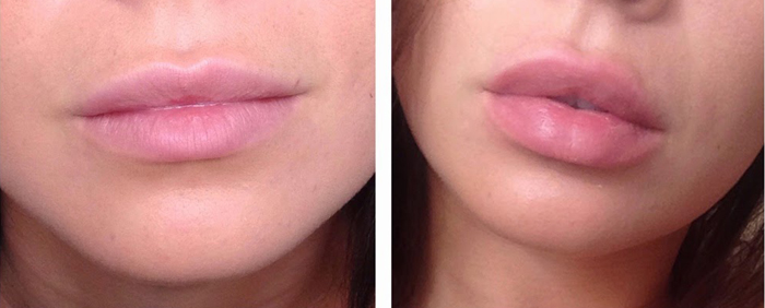 Lip-Enhancer-Labbra-carnose-senza-chirurgia1